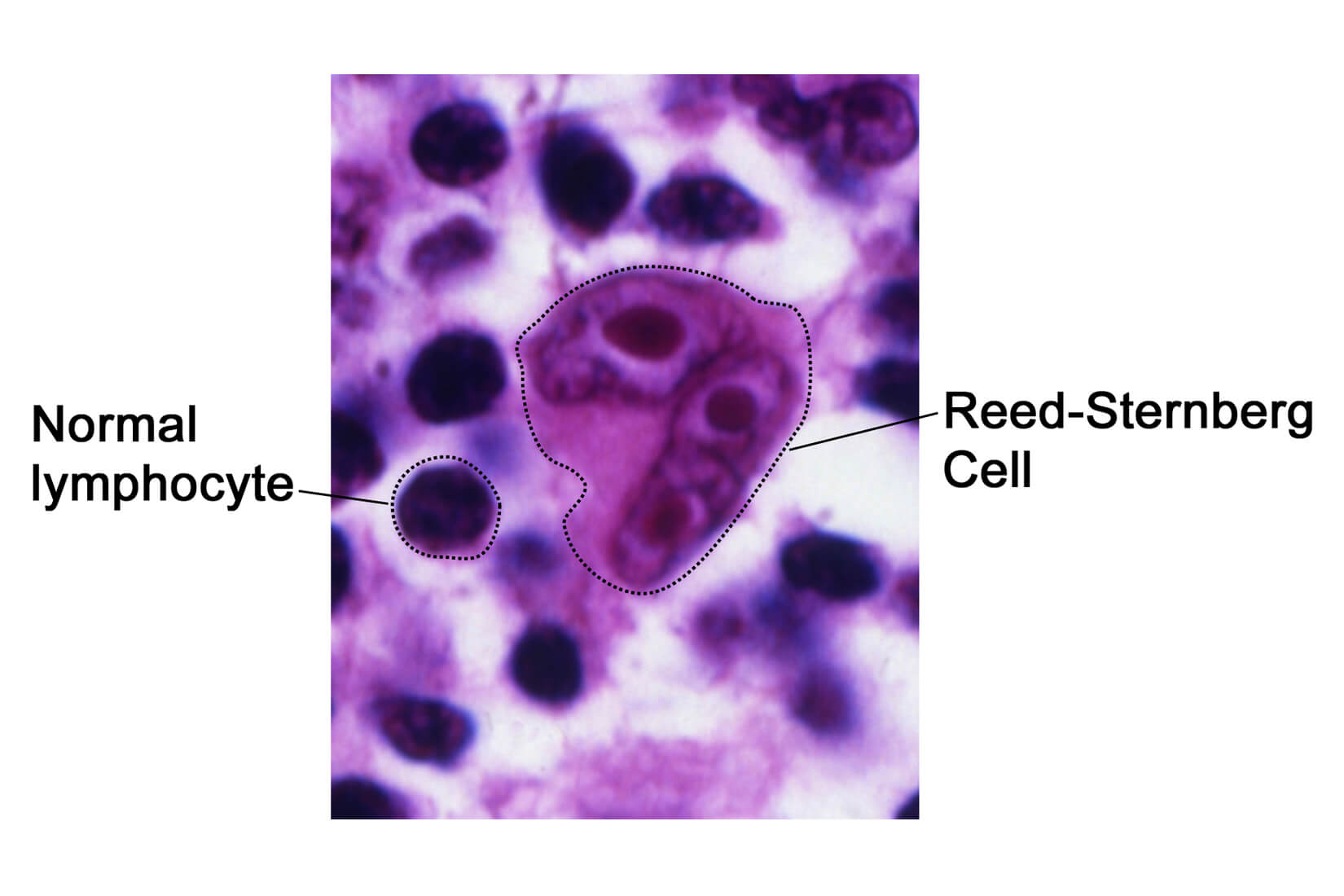 New Therapy Options Recently Approved for Hodgkin’s Lymphoma